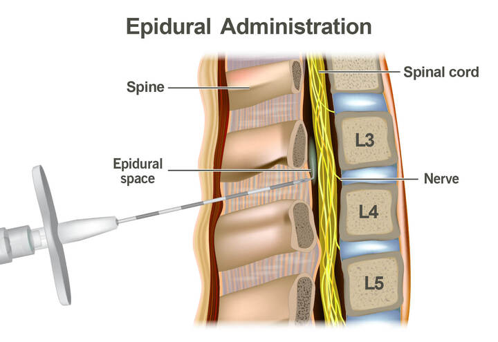 Epidural administration