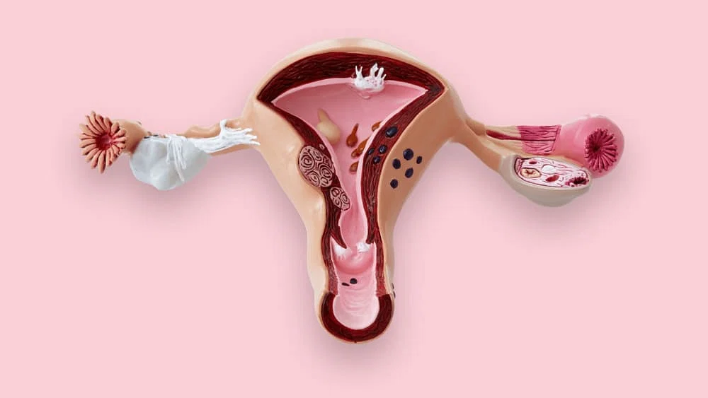 Hypogonadism